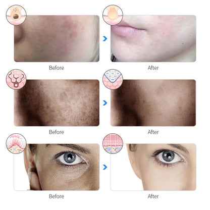 LumaGlow LED Face Mask
